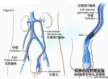 精索静脉曲张有哪些明显症状