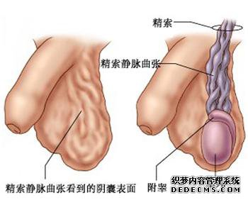 精索静脉曲张是怎么危害男性生育